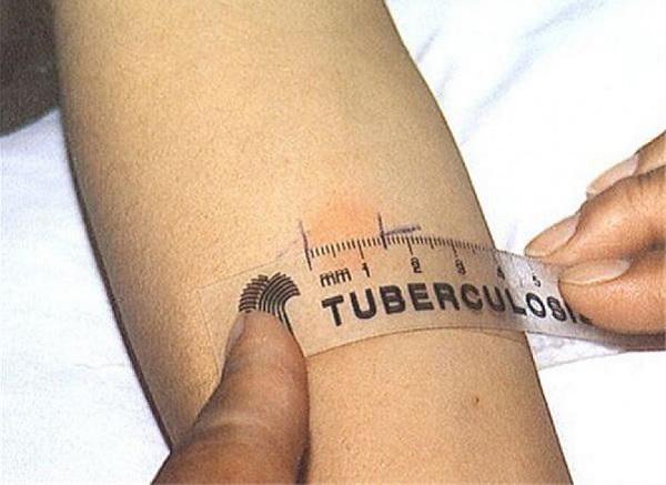 Налице е тенденция за трайно намаляване на заболяемостта от туберкулоза