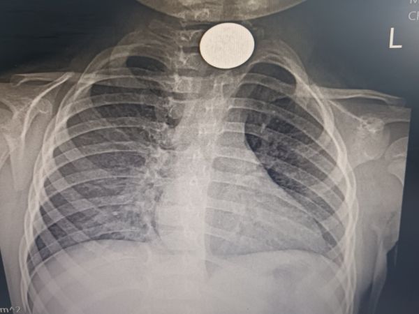 Лекари от УНГ отделението на УМБАЛ Бургас спасиха дете живяло месец