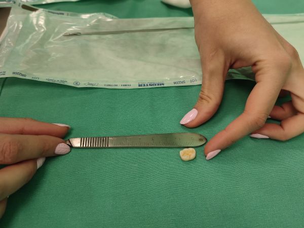 В Клиниката по УНГ болести на УМБАЛ Бургас спасиха 11 годишно