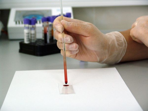 Световни компании разработват кръвни тестове за болестта на Алцхаймер
