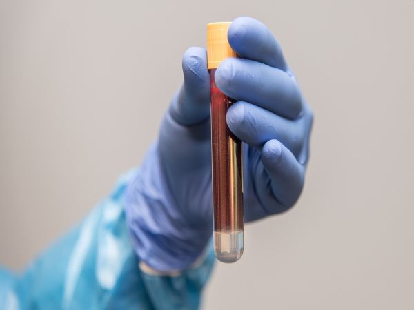Великобритания: Кръвен тест може би ще измести биопсията при съмнение за рак на простатата   