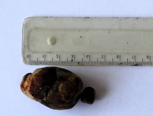 Хирурзи от УМБАЛ Пловдив направиха операция на изключително рядкото усложнение на