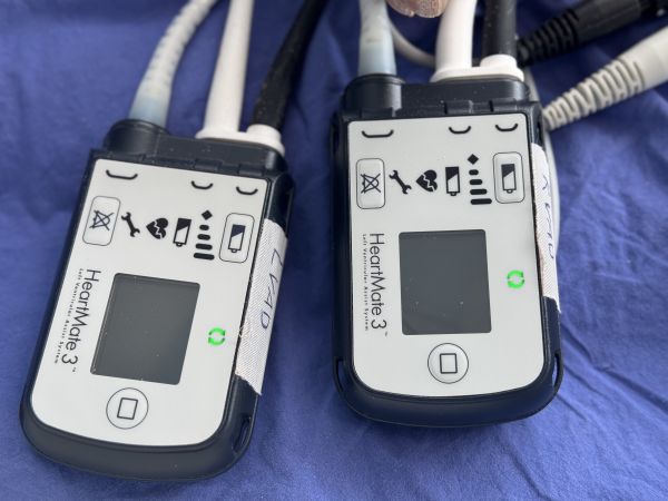 Мъж с крайна форма на сърдечна недостатъчност получи втори шанс