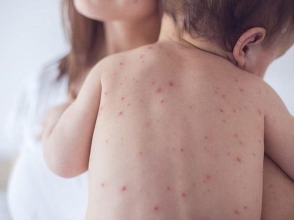 Тази година шестгодишно дете преболедувало морбили през 2019 г е