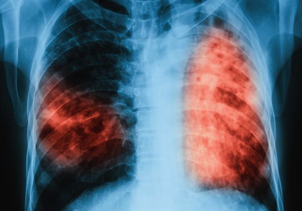 Започват безплатни прегледи за туберкулоза в цялата страна