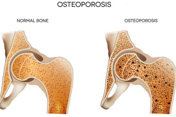 Над 400 000 са диагностицирани с остеопороза у нас, още толкова са в риск
