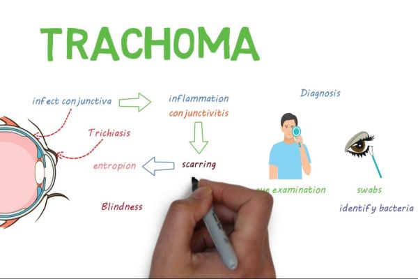 С 91% са намалели хората, изложени на риск от трахома