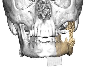 Уникално за Югоизточна Европа трансплантиране на челюст извършиха в „Пирогов“