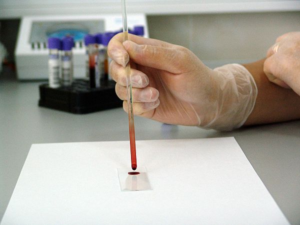 След Великобритания и Португалия потвърди за случаи на маймунска шарка
