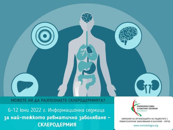 Няма яснота колко са болните от склеродермия у нас