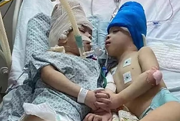 Успешно разделиха сиамски близнаци със слети мозъци чрез виртуална реалност