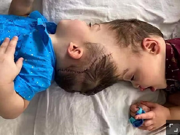 Успешно разделиха сиамски близнаци със слети мозъци чрез виртуална реалност