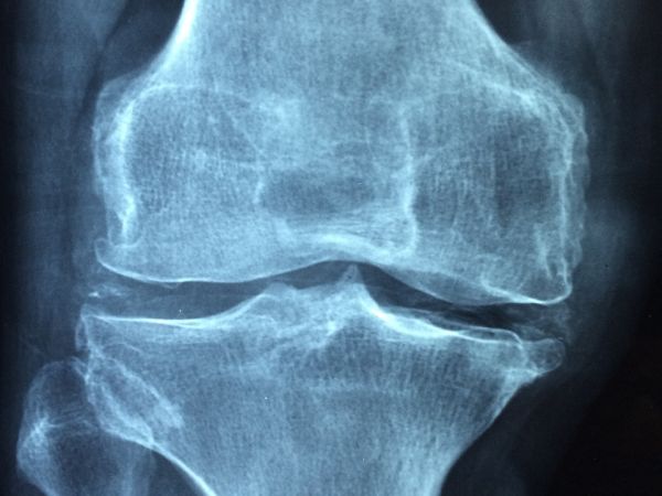 На всеки час в България се регистрират по шест фрактури в резултат на остеопороза