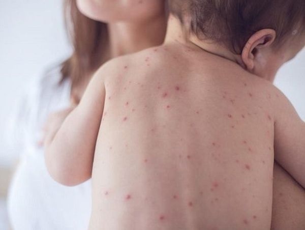 Румъния регистрира нови 270 случая на морбили от 17 и 24 декември