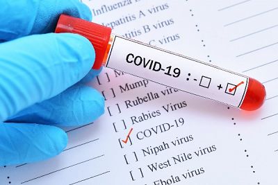503 са потвърдените случаи на COVID-19 у нас, медицинските служители са 23-ма