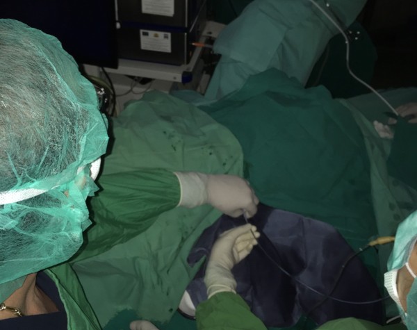 В УМБАЛ Бургас спасиха бъбрека на жена с иновативна операция