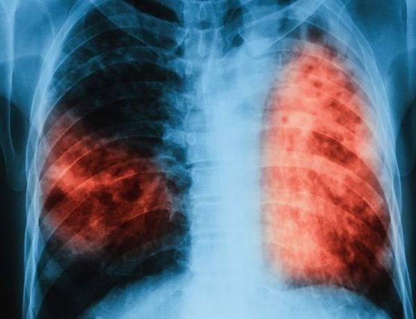 МЗ дава половин милион по програмата за борба с туберкулозата      
