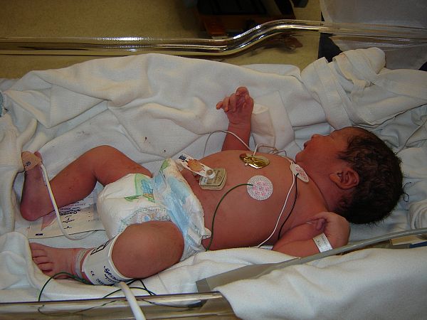 В САЩ трансплантираха успешно сърце и тимус на 6-месечно бебе 