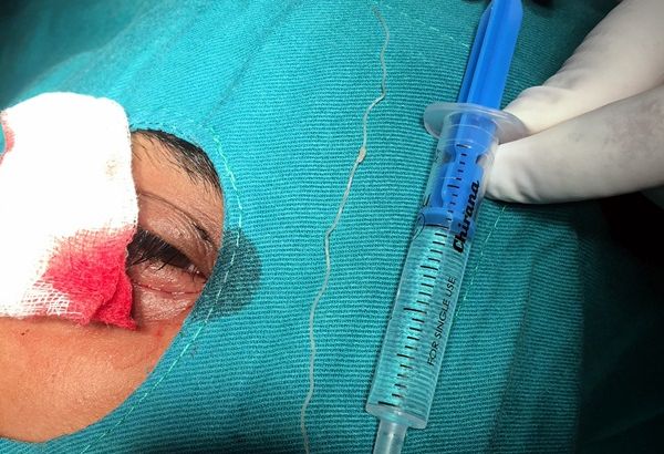 Три дни вадят 10-сантиметров паразит от окото на пациент в Плевен