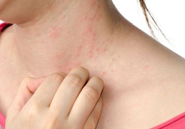 Увеличаване на кожните алергии очакват дерматолози