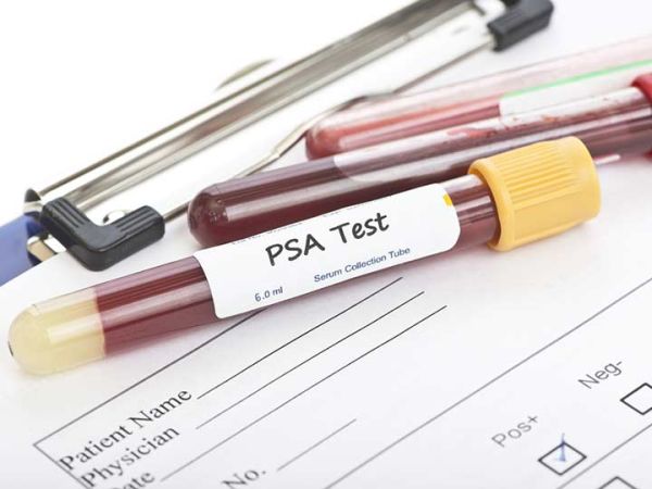 PSA туморният маркер трябва да се следи ежегодно