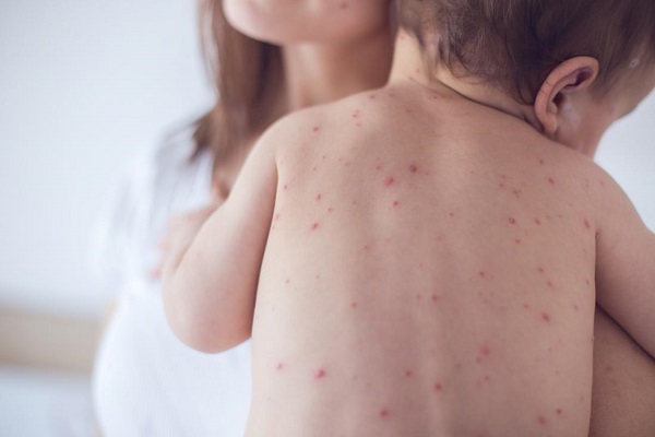 В Пловдив издирват деца без ваксинация срещу морбили